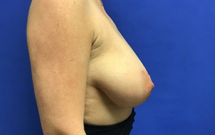Breast Implants and Lift case #3069
