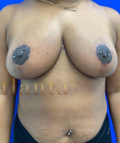 | Arslanian Plastic Surgery Atlanta Before & After Plastic Surgery Results | breast procedure