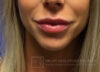 Fillers case #3535