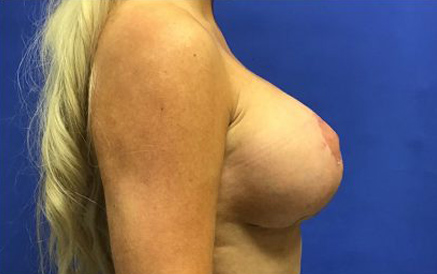 Breast Implants and Lift case #3069