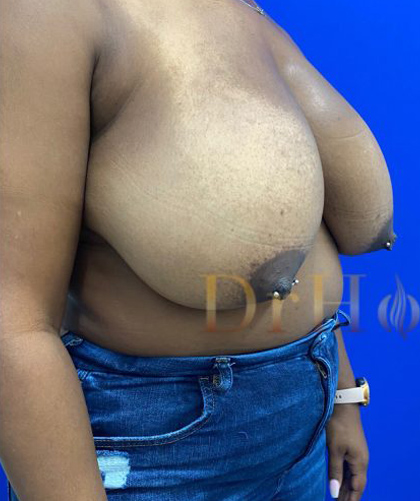 Breast Reduction case #2967