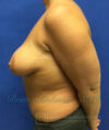 Breast Augmentation case #2608