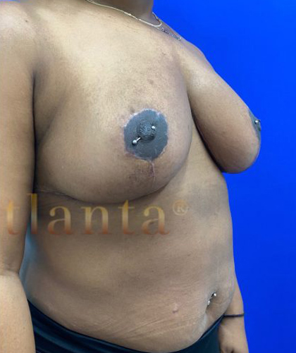 Breast Reduction case #2967