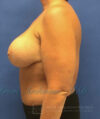 Breast Augmentation case #2608