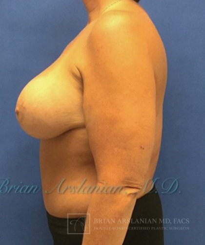 Breast Augmentation case #2608