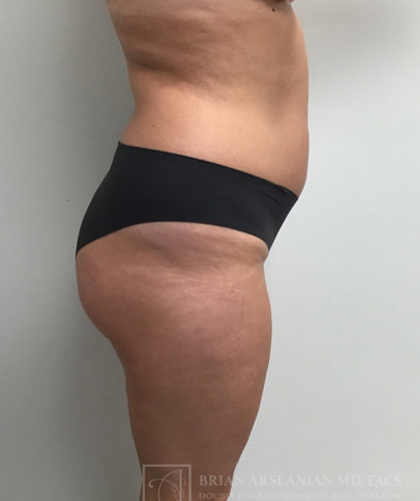 Brazilian Butt Lift case #3653