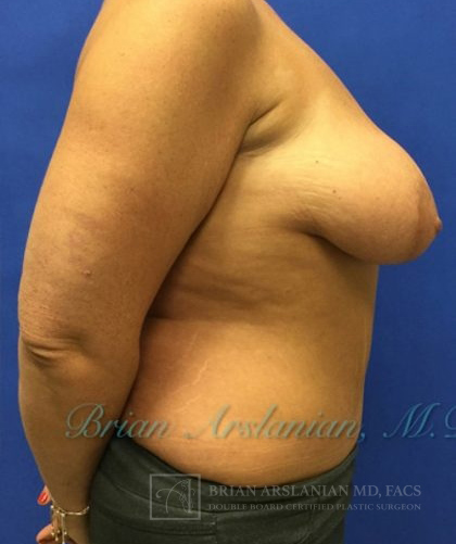 Breast Augmentation case #2608