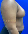 Breast Reduction case #2967