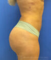 Brazilian Butt Lift case #3653