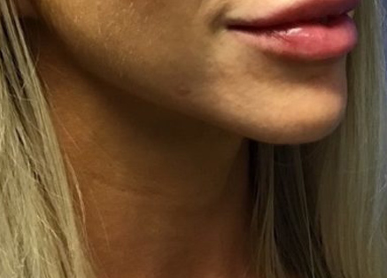 Fillers case #3535