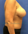 Breast Augmentation case #2608