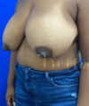 Breast Reduction case #2967