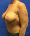 Breast Augmentation case #2608