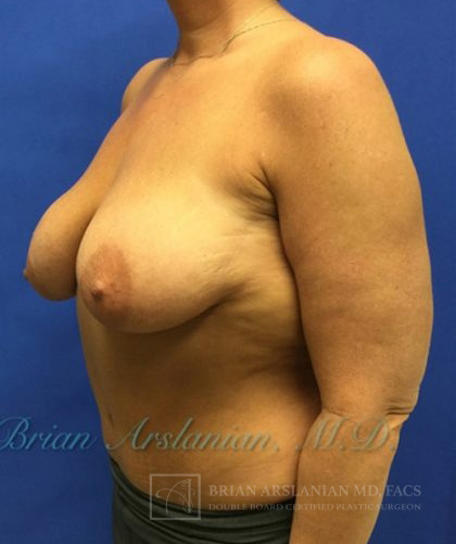 Breast Augmentation case #2608