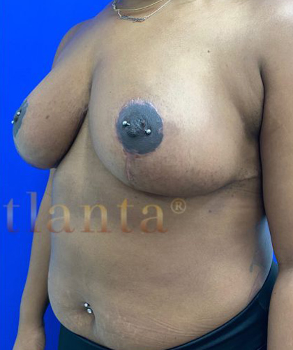 Breast Reduction case #2967