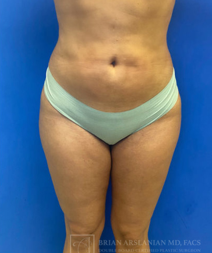 Brazilian Butt Lift case #3653