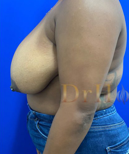 Breast Reduction case #2967