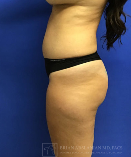 Liposuction case #3663