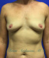 Breast Augmentation case #2619