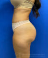 Liposuction case #3663