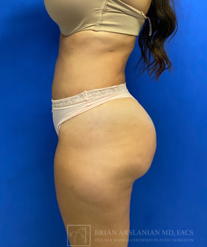 Liposuction case #3663