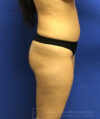 Liposuction case #3663