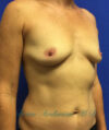 Breast Augmentation case #2619