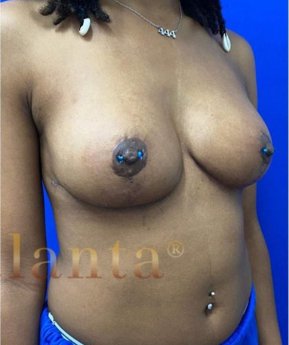 Breast Lift case #2979