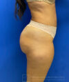 Liposuction case #3663