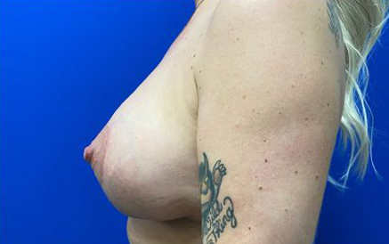 Breast Implants and Lift case #3078