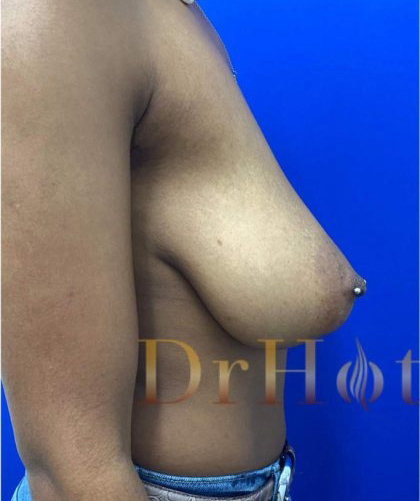 Breast Lift case #2979