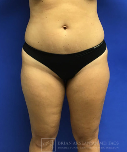 Liposuction case #3663