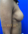 Breast Lift case #2979