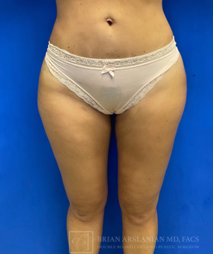 Liposuction case #3663