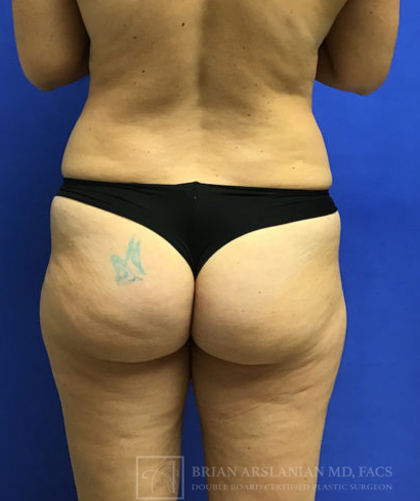 Liposuction case #3663