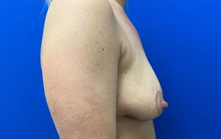 Breast Implants and Lift case #3078