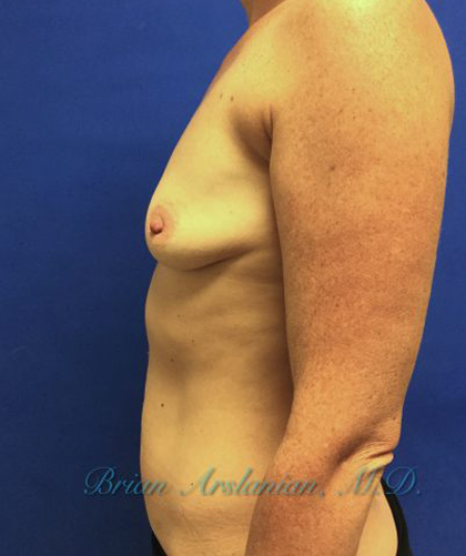 Breast Augmentation case #2619