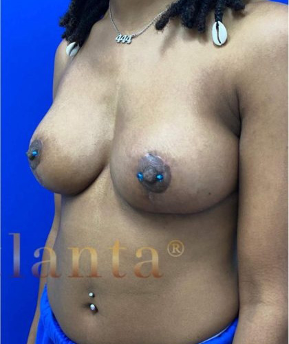 Breast Lift case #2979