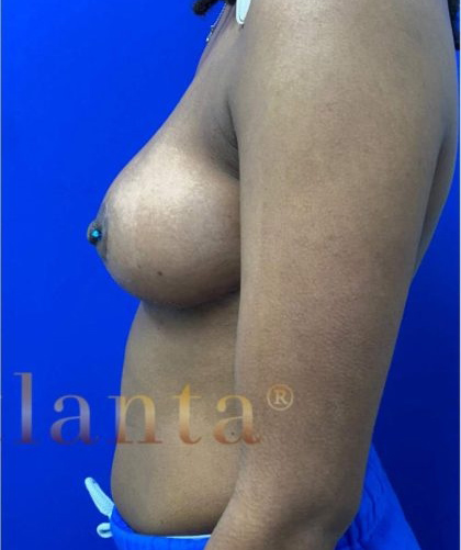 Breast Lift case #2979