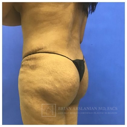 Brazilian Butt Lift case #2127