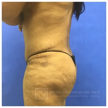 Brazilian Butt Lift case #2127