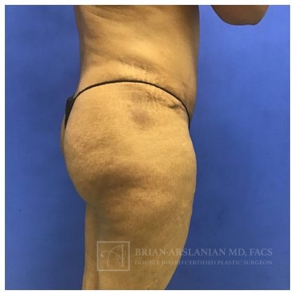 Brazilian Butt Lift case #2127