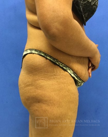 Brazilian Butt Lift case #2127