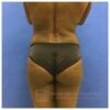 Brazilian Butt Lift case #2158