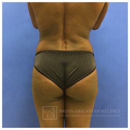 Brazilian Butt Lift case #2158