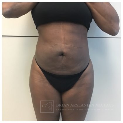 Brazilian Butt Lift case #2158