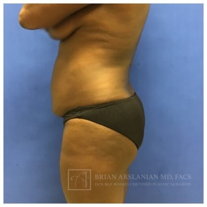 Brazilian Butt Lift case #2158