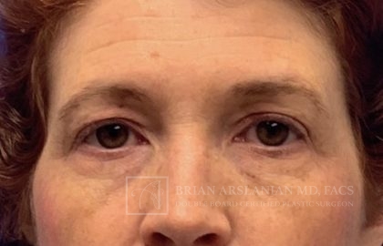 | Arslanian Plastic Surgery Atlanta Before & After Plastic Surgery Results | facial procedure