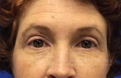 Blepharoplasty case #2118