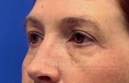 Blepharoplasty case #2118